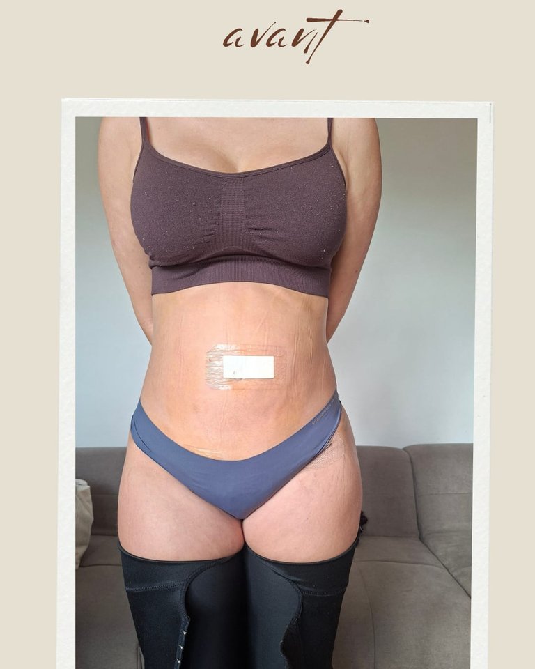 Avant l'accompagnement en drainage lymphatique