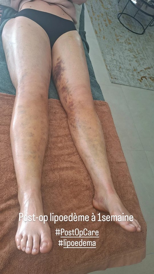 Post-op lipœdème — suivi à 1 semaine