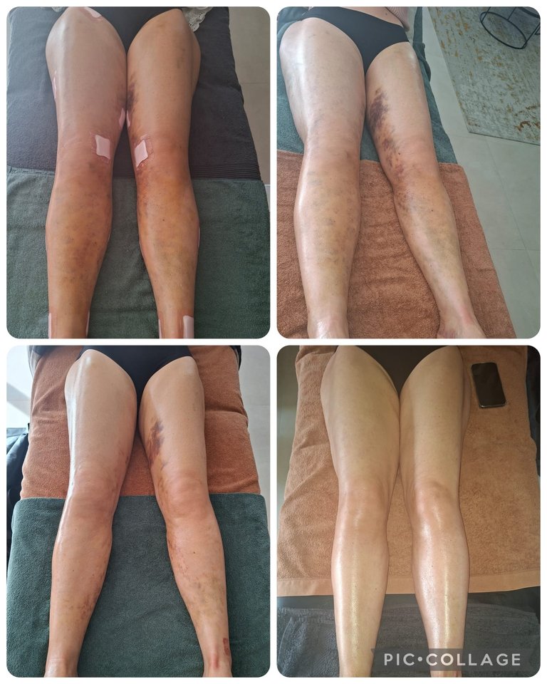 Évolution des jambes en post-opératoire — collage