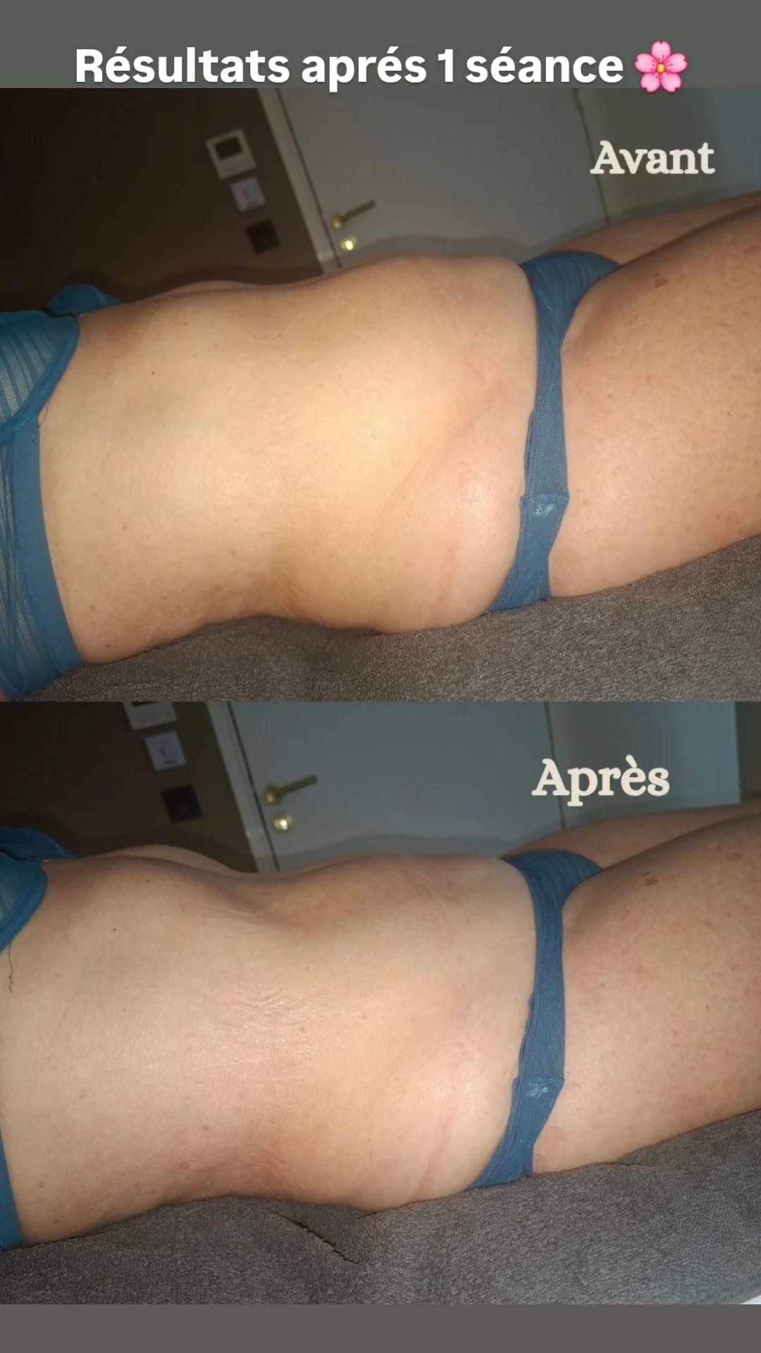 Avant et après une séance de drainage lymphatique Renata França : ventre affiné et silhouette plus sculptée